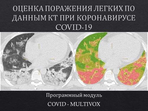 Сотрудники ФФМ в составе научного коллектива разработали программу для оценки поражения легких по КТ без участия врача-диагноста Сотрудники ФФМ в составе научного коллектива разработали программу для оценки поражения легких по КТ без участия врача-диагноста